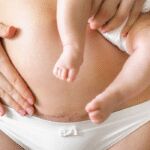 Moeders die een keizersnede hebben gehad, hebben 16% meer kans op deze stoornis