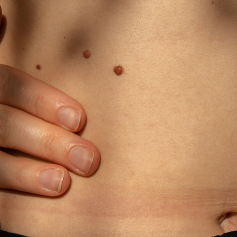 Illustratie bij: Lijfdossier: zo herken je huidkanker, volgens een dermatoloog