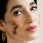 Padminie Gajadhar heeft universele vitiligo: ‘Ik kreeg de vraag of mijn make-up was uitgelopen’