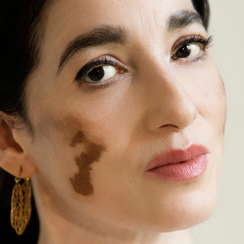 Illustratie bij: Padminie Gajadhar heeft universele vitiligo: ‘Ik kreeg de vraag of mijn make-up was uitgelopen’