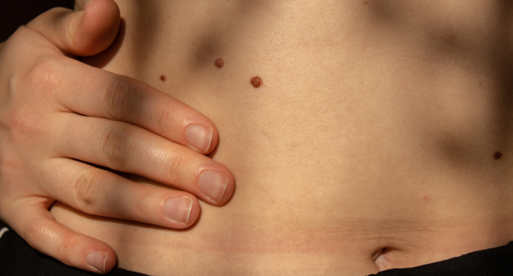 Illustratie bij: Lijfdossier: zo herken je huidkanker, volgens een dermatoloog
