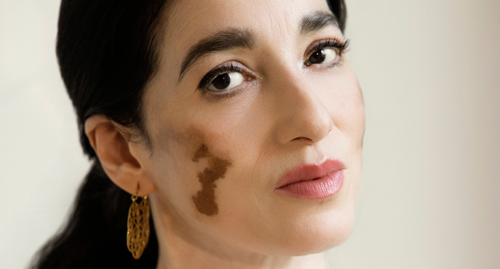 Illustratie bij: Padminie Gajadhar heeft universele vitiligo: ‘Ik kreeg de vraag of mijn make-up was uitgelopen’